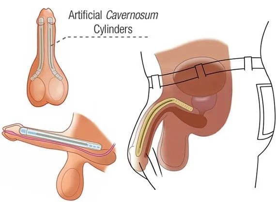 阴茎假体植入价格及相关因素深度探讨