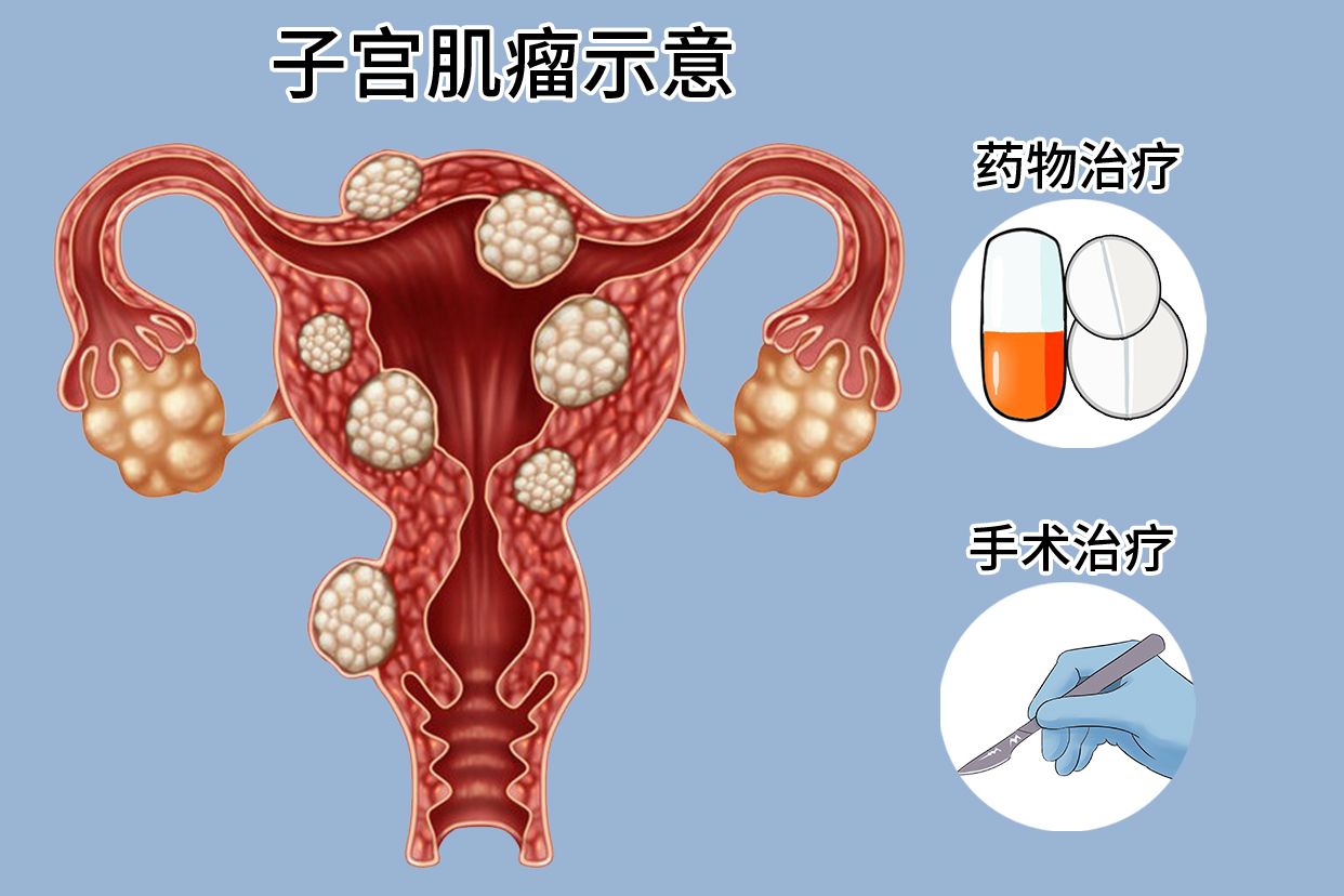 子宫腺肌瘤最新最佳治疗方法，探索与理解