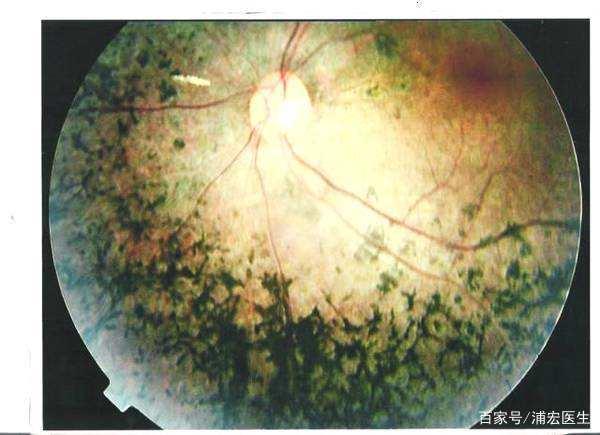 视网膜色素变性治疗最新进展揭秘