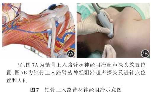 臂丛神经最新治疗方法的研究与应用进展