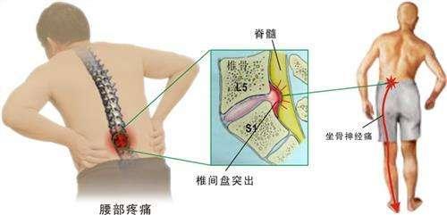 腰间盘突出最新疗法研究与应用进展